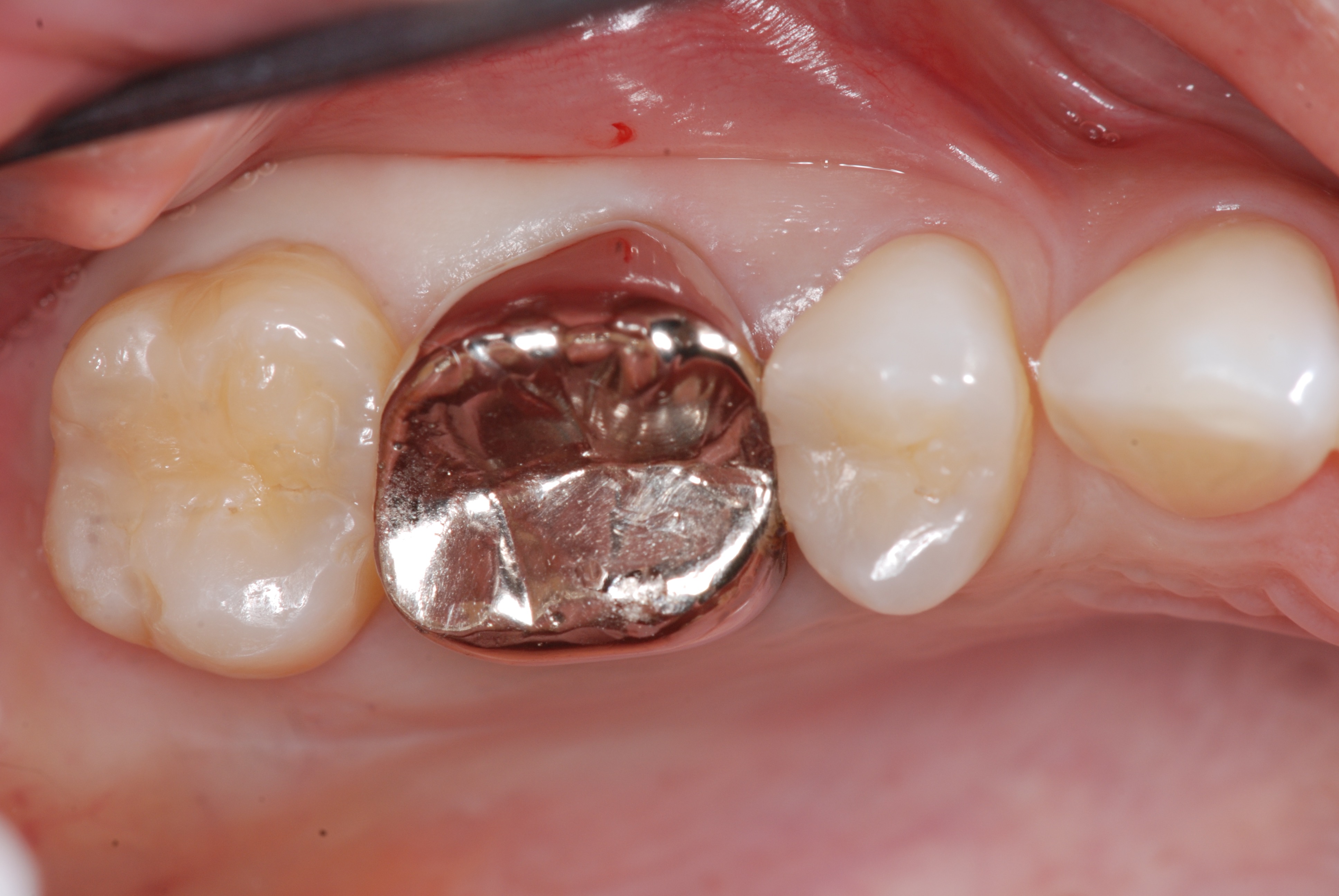 歯 の 治療 白い 被せ 物