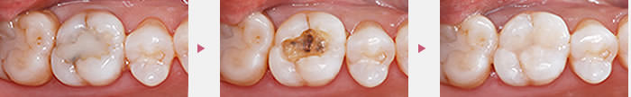 臼歯 - 虫歯治療