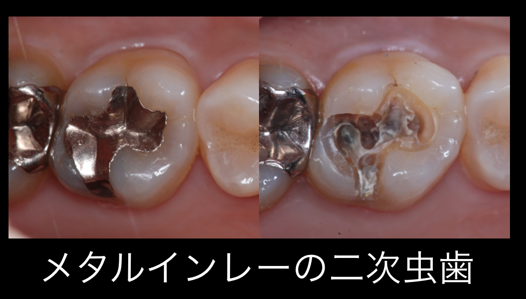 保険診療の詰め物について：コンポジットレジンVSメタルインレー（銀歯） | 浅井歯科医院