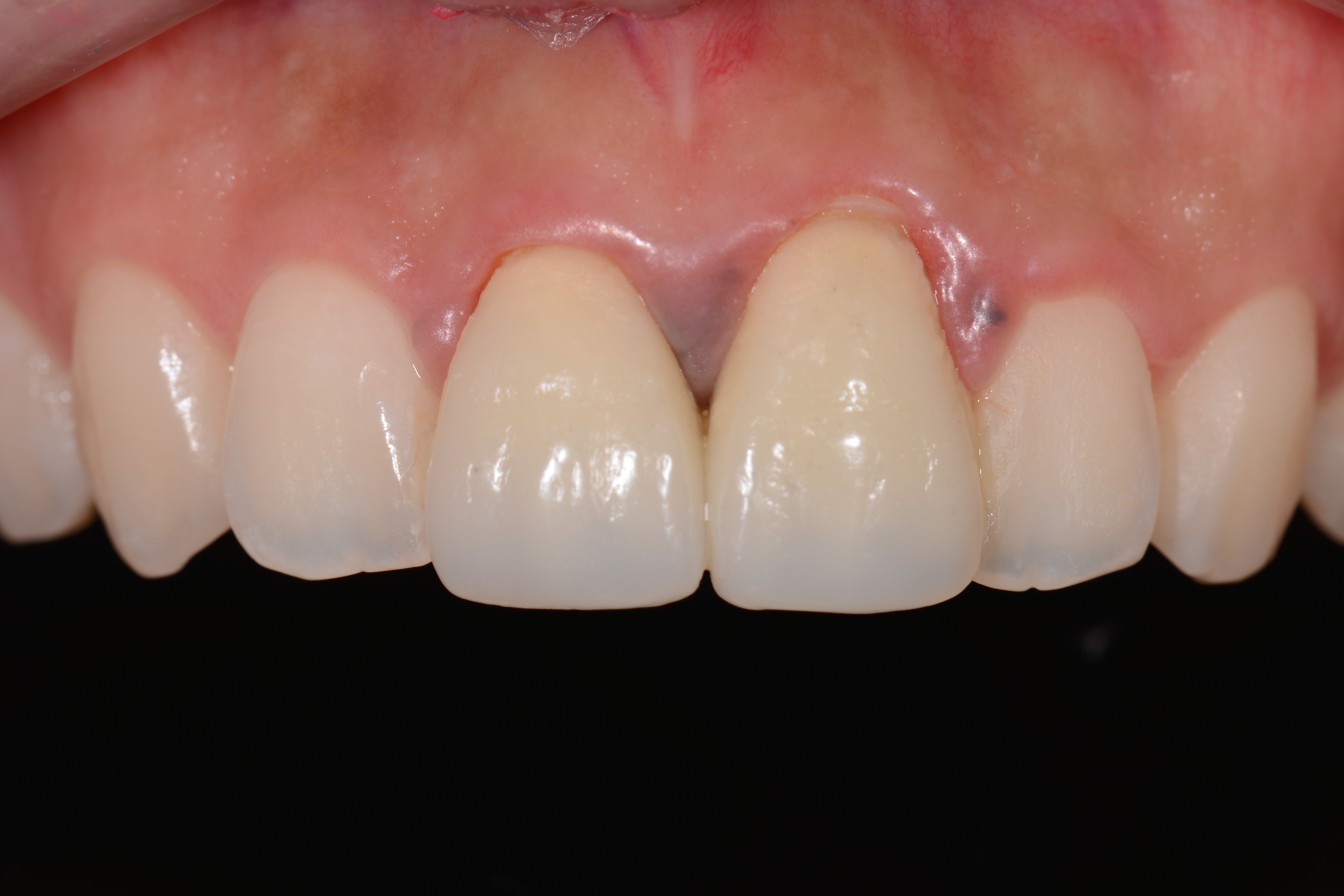 奥歯 の 歯茎 の 腫れ
