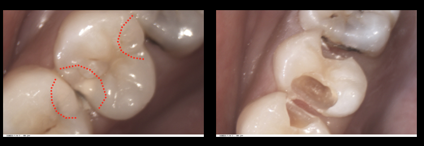 コンポジットレジン充填（ダイレクトボンディング）治療について：新潟