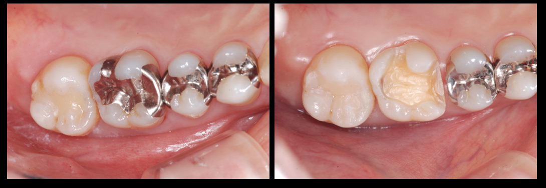 銀歯（メタルインレー）の二次カリエスをCEREC（セレック）を用いた