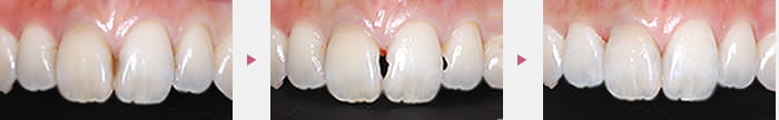 前歯 - 虫歯治療